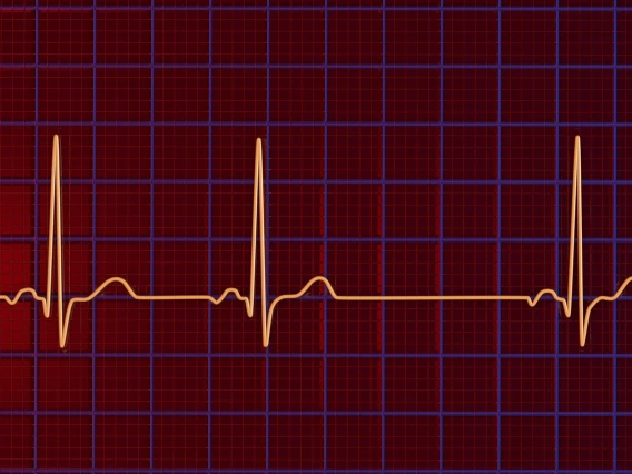 illustration of an electrocardiogram displaying sinus arrhythmia