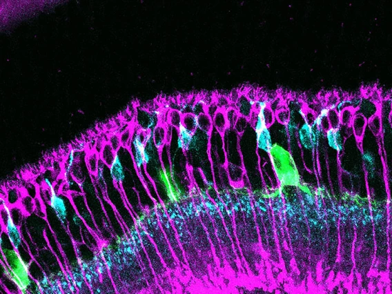 Scientists are studying images taken under a microscope, such as this image from diabetic and control retinas, to understand the cellular changes that occur in the early stages of diabetes, before vision loss occurs. This image shows rod bipolar cells in magenta, some cone bipolar cells in cyan, and dopaminergic amacrine cells in green.