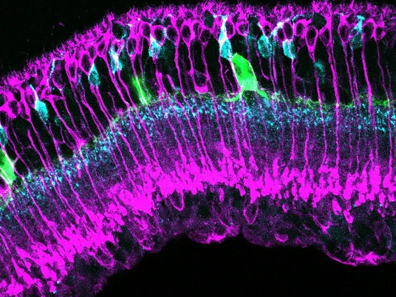 This image shows different types of retina cells labeled in green, magenta and cyan. Scientists are studying images like this from diabetic and control retinas to understand the cellular changes that occur in the early stages of diabetes, before vision loss occurs.