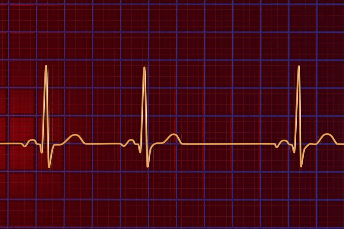 illustration of an electrocardiogram displaying sinus arrhythmia