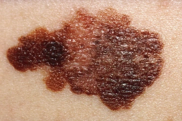 Melanoma, skin cancer