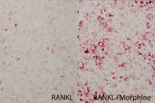 A diagram showing two sets of breast cancer cells